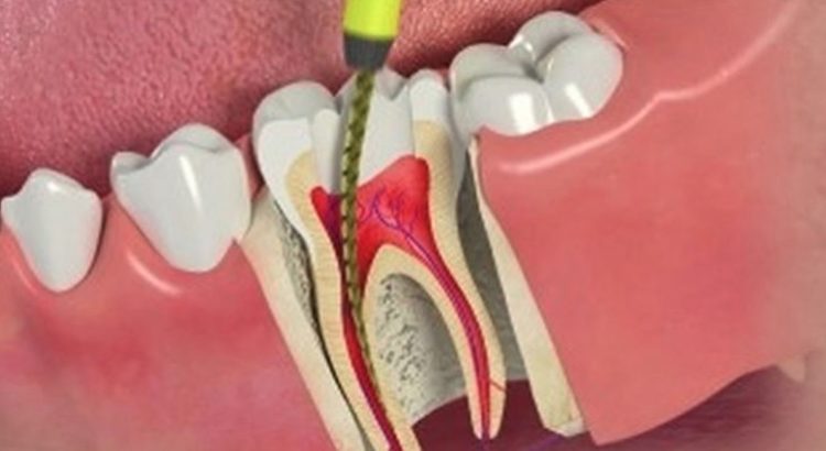 Root Canal Cost and How to Reduce Them | Dentist Canberra