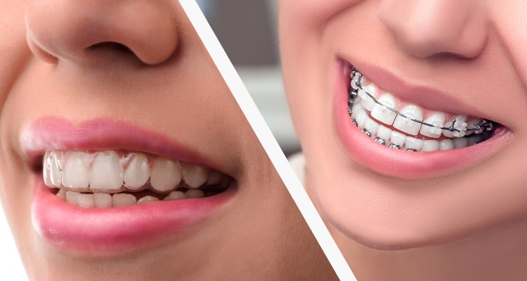 Cost Difference Between Braces and Invisalign