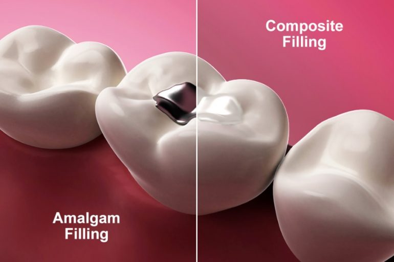 How Much Does A Filling Cost? Civic Gentle Dental Care