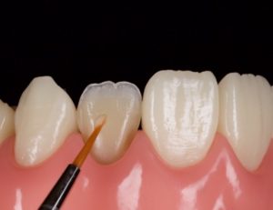 Composite Resin Veneers