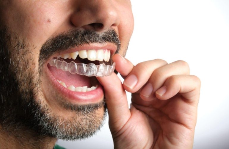 How Long Does Invisalign Take