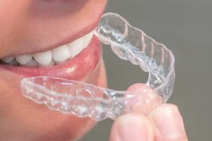 How Long Does Invisalign Take