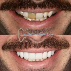 Veneers Before and After