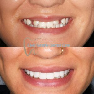 Veneers Before and After