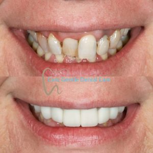 Veneers Before and After